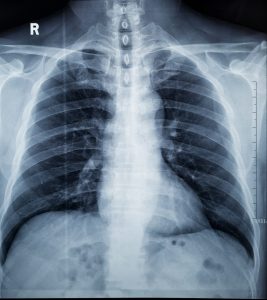 What does vaping do to your lungs?
